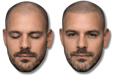 Before and after scalp micropigmentation treatment for male pattern baldness showing a restored hairline.