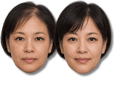 Before and after SMP hair loss treatment results for an Asian woman with thinning hair on the crown.