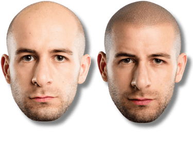 Before and after scalp micropigmentation results showing a realistic hair tattoo for male pattern baldness.