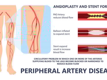 Peripheral artery bypass surgery