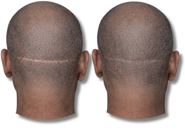 Before and after scalp micropigmentation results for concealing a linear hair transplant scar.