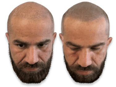 Before and after scalp micropigmentation results for a man with a buzzed haircut to treat hair loss.