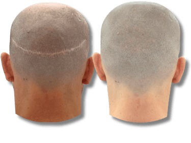Before and after scalp micropigmentation results for FUT hair transplant scar camouflage.