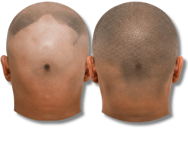 Before and after scalp micropigmentation treatment for male pattern baldness and hair loss.