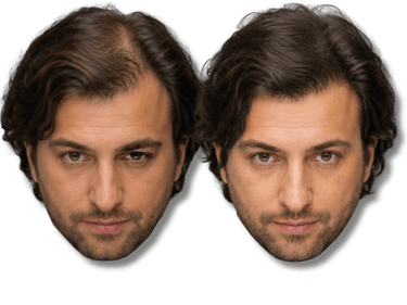 Before and after comparison of a man with thinning hair using hair loss restoration treatment.