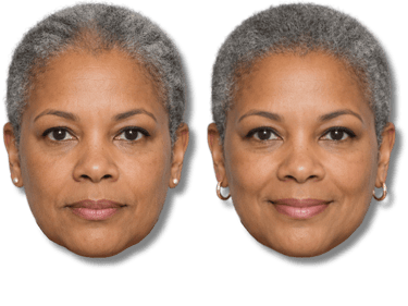 Before and after comparison of a smiling woman showing facial rejuvenation results.