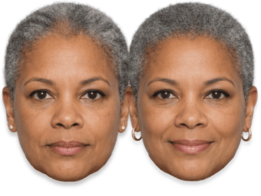 Before and after comparison of a woman's SMP results for thinning gray hair.
