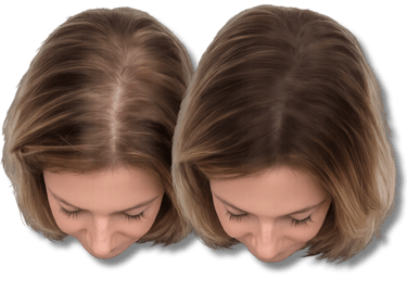 Before and after comparison of female hair thinning and restoration results on the scalp.