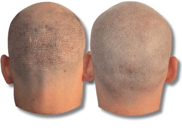 Before and after scalp micropigmentation results for a shaved head with hair follicle density.