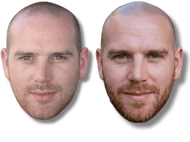 Before and after results of scalp micropigmentation for hair loss on a bald man with a beard.