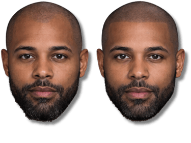 Before and after scalp micropigmentation showing a restored hairline for a man with hair loss.