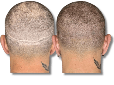 Before and after scalp micropigmentation for concealing a hair transplant FUT scar.
