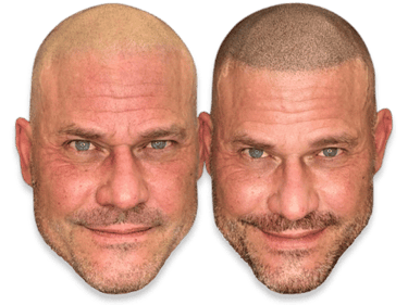 Before and after scalp micropigmentation treatment for male pattern baldness and hair density.