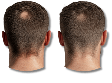 Before and after comparison of hair regrowth treatment for a bald spot on a man's crown.