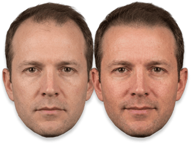 Before and after SMP results showing improved hairline and hair density in a middle-aged man.
