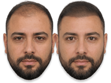 Before and after comparison of a man's SMP results showing a restored hairline.