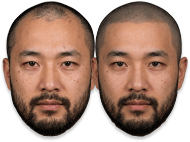Before and after scalp micropigmentation showing a man's restored hairline for thinning hair treatment.
