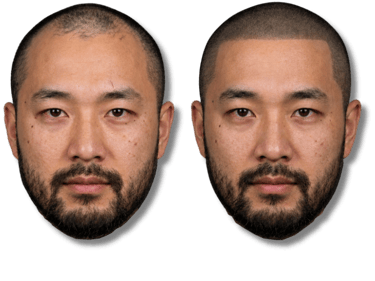 Scalp micropigmentation before and after results on a man with thinning hair and a receding hairline.