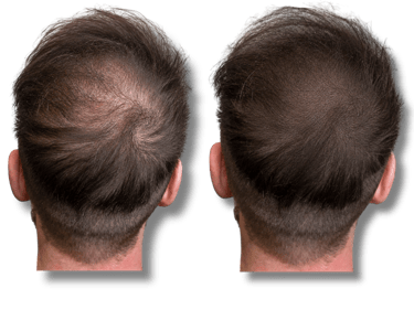 Before and after hair transplant results showing increased density and hair growth on a man's crown.