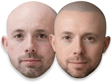 Before and after comparison of scalp micropigmentation for hair loss on a bald man's head.