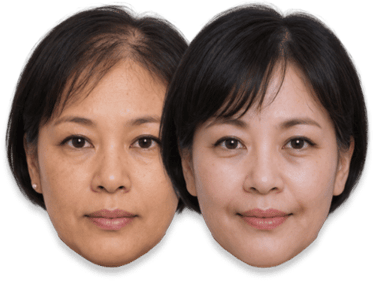Before and after results of SMP treatment and skin rejuvenation for an Asian woman.