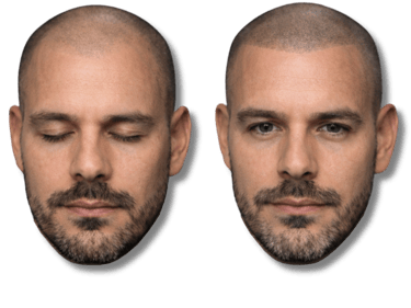 Before and after scalp micropigmentation results for male pattern baldness and hairline restoration.