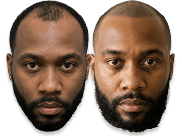 Before and after scalp micropigmentation results for a man with a thinning hairline and male pattern baldness.