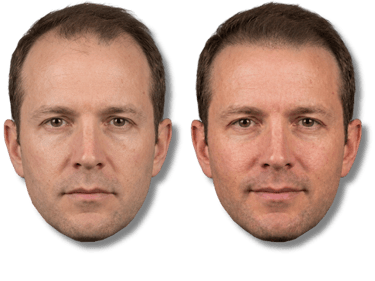 Before and after comparison of a man's scalp micropigmentation results for treating male baldness.