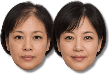 Before and after comparison of a woman showing hair loss treatment results for thinning hair.