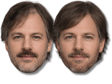 Before and after comparison of a man receiving hair restoration treatment for thinning hair.