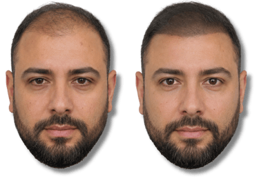 Before and after SMP results showing a man with increased hair density on his scalp.