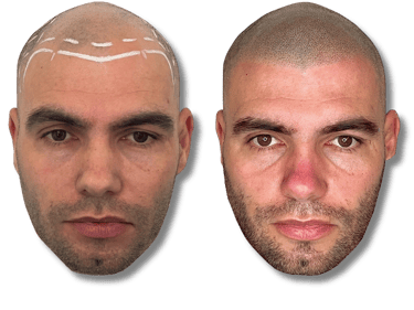 Before and after scalp micropigmentation treatment showing a restored hairline and denser hair follicles on a bald man.