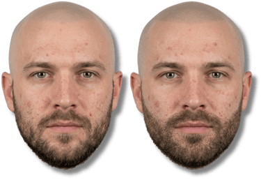 Before and after face comparison of a man with acne and skin blemishes on a black background.
