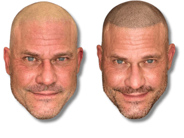 Before and after scalp micropigmentation results for a bald man showing a natural hairline tattoo.