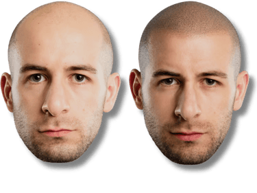 Before and after results of scalp micropigmentation for hair loss treatment on a bald man.