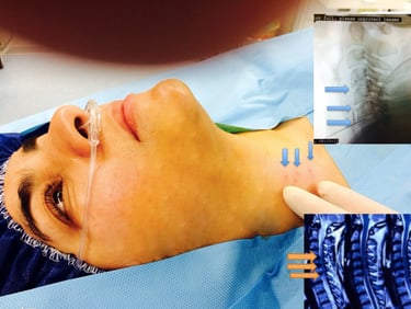 Discogel injection for 3 level Cervical herniated discs