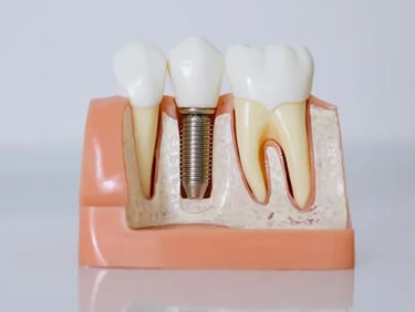 Implantes dentales en Sevilla