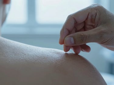 Macro close-up of a therapist's hand inserting a fine dry needling needle into a client's trapezius muscle, showing sterile technique and precise placement, soft clinical blue lighting.