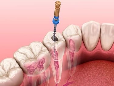 Instrumentação canal em Dentista 24 horas