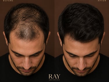 PRP hair restoration Toronto