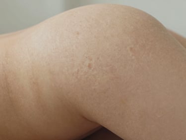 Extreme close-up of skin surface on the thigh showing cellulite texture under diffused north-facing daylight, clinical framing with high detail, no filters, practitioner hand visible at edge for scale