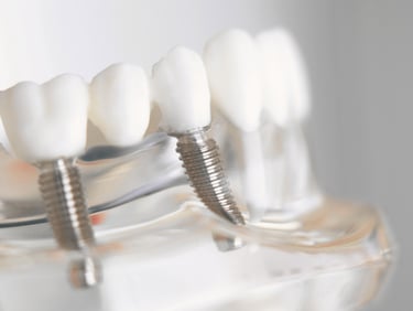 datu implantacija