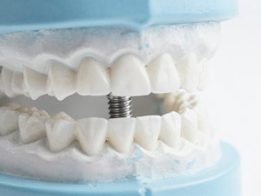 Macro shot of a high-quality dental implant model, clean white background, soft daylight, light blue medical accents