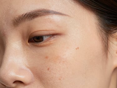 Macro close-up of forehead and cheek skin showing melasma pigmentation patches under cool-white clinical lighting, skin tone diversity, no filters, texture fully visible