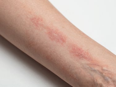 Macro close-up of reddened sensitive skin with eczema patches on forearm under neutral clinical lighting, texture and irritation clearly documented, sterile white background