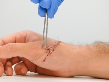 A doctor using tweezers to perform suture removal on a healing hand incision.