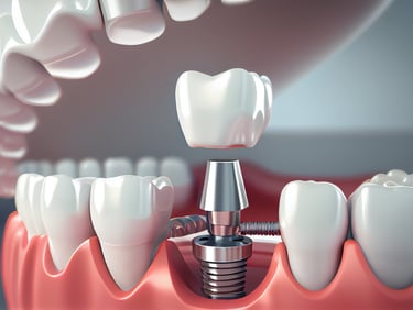 kırıkkale diş, implant tedavisi, implant diş, diş hekimi, diş