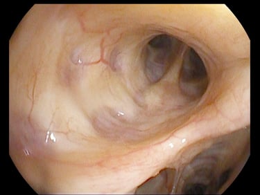 Bronchoscopy in Malta