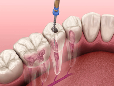 Endodontia Odonto Medyc