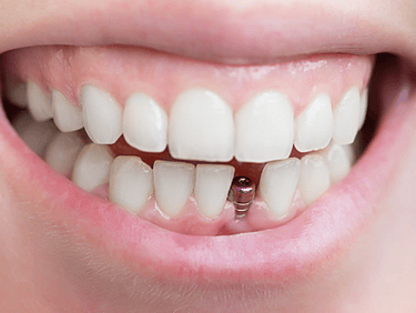 Implantodontia Odonto Medyc